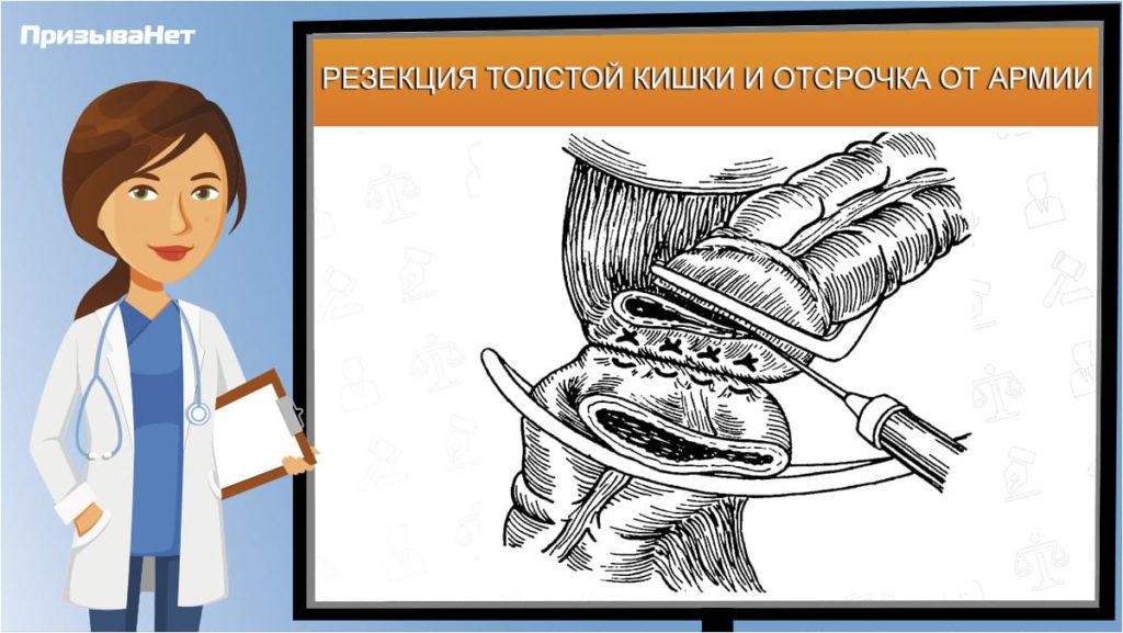 Резекция толстой кишки и отсрочка от армии