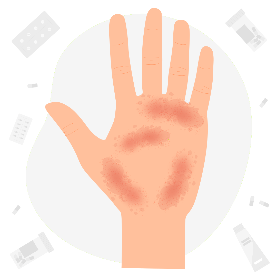 Пиодермия язвенная и армия