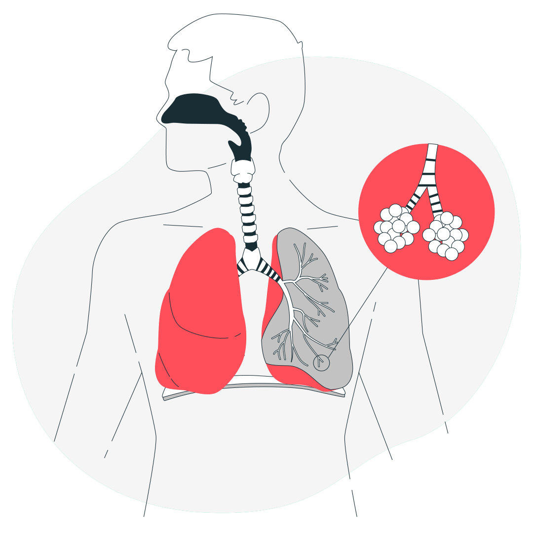 Бронхоэктазы