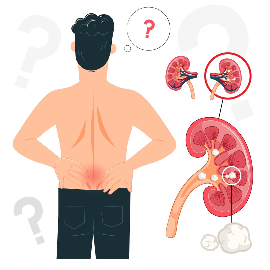 камни в почках