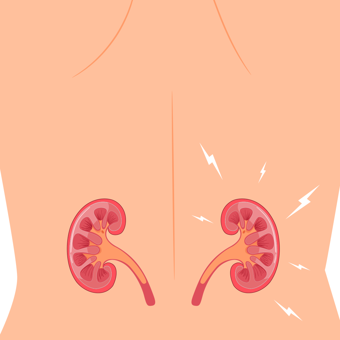 Нефункционирующая почка и армия