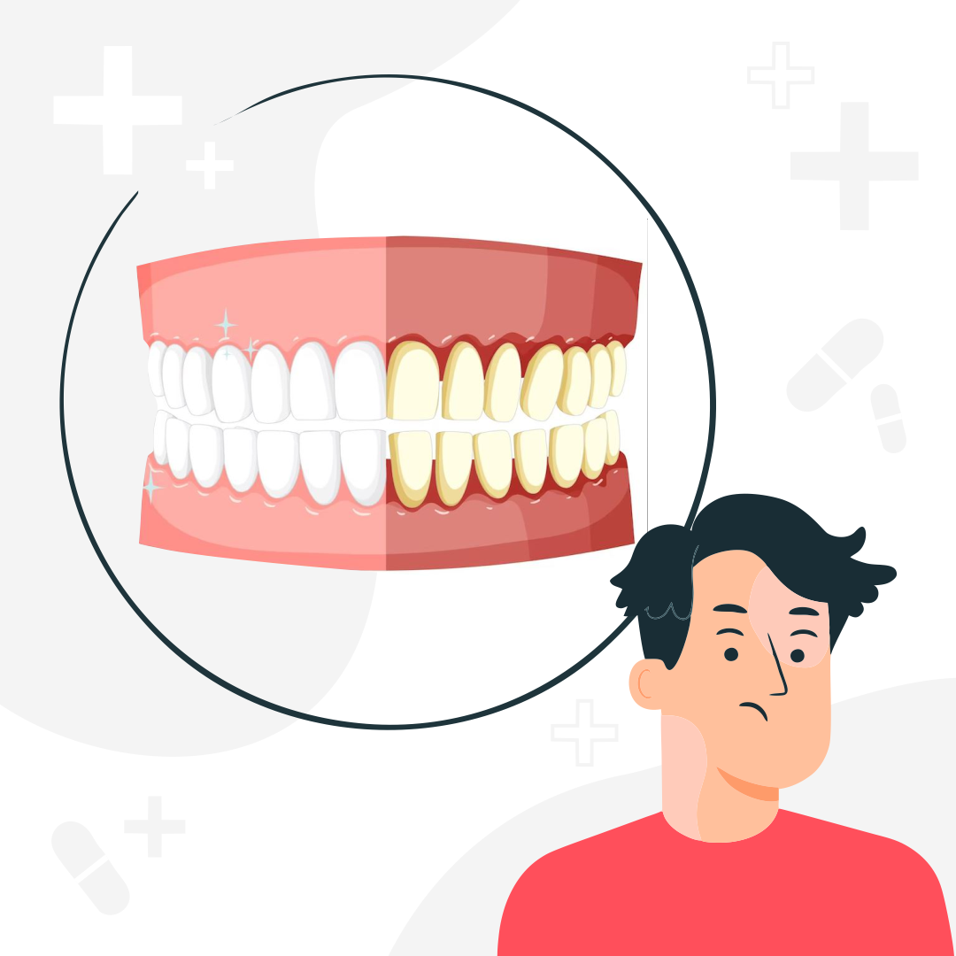 Пародонтит