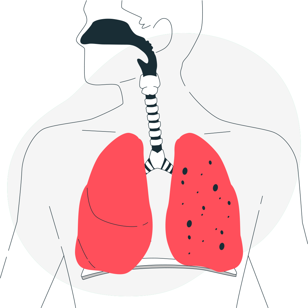 Саркоидоз (1 и 2 стадии) и армия
