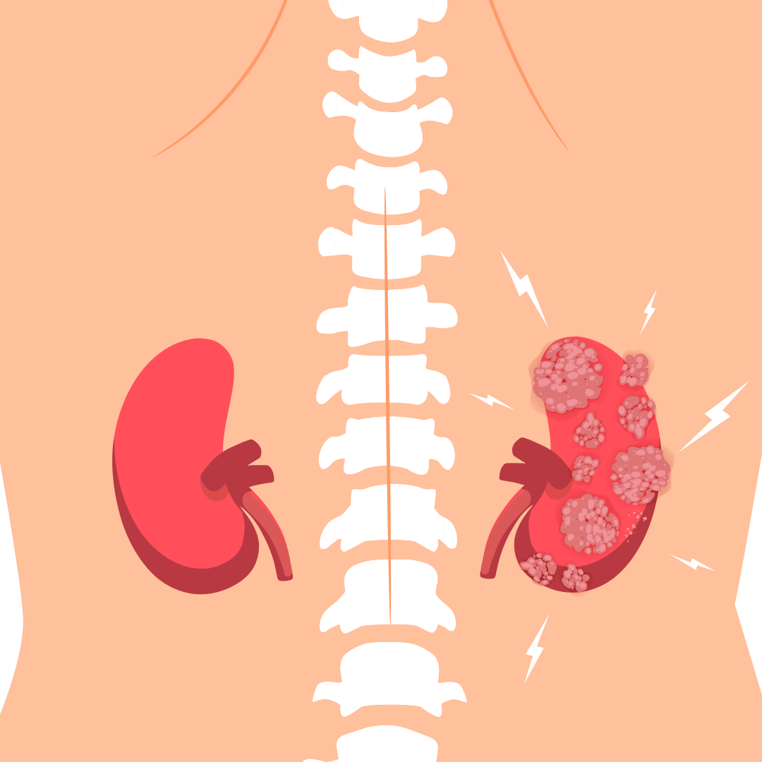 Туберкулез мочеполовых органов и армия