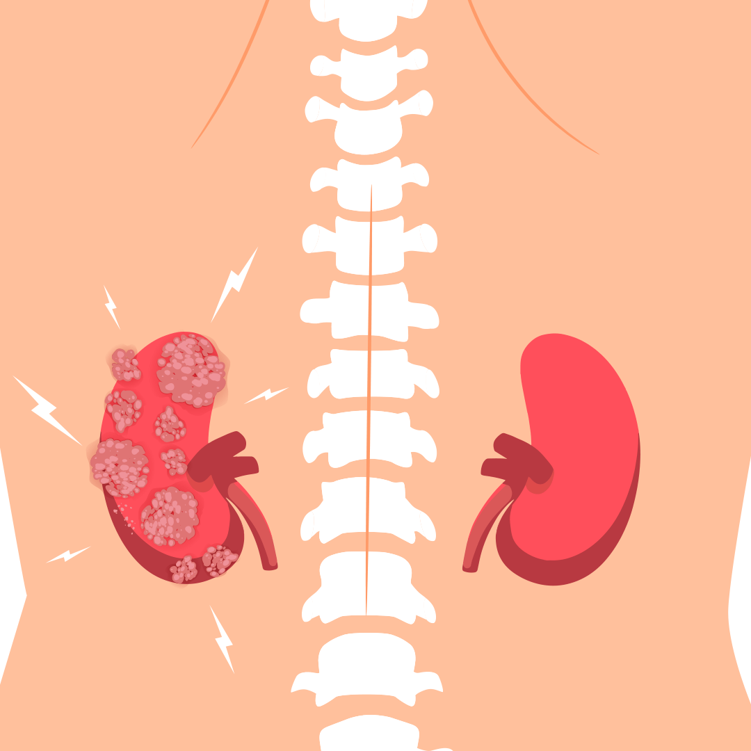 Хронический интерстициальный нефрит и отсрочка от армии